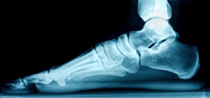 Flat Foot Types and Appropriate Exercises
