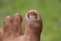 When Toenails Fall Victim to Fungi