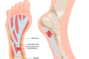 Exploring Plantar Fasciitis Surgery
