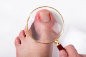 Who Is at Risk for Ingrown Toenails?