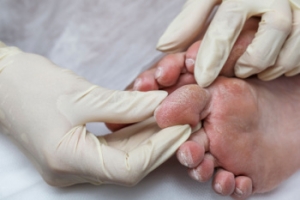 How Diabetic Patients Should Care for Their Feet