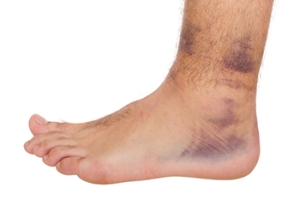 Ankle Sprains and Peripheral Nerve Damage