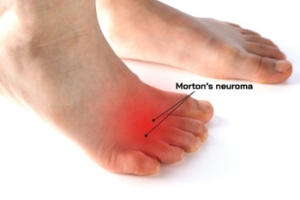 Treatment Methods for Morton&#039;s Neuroma