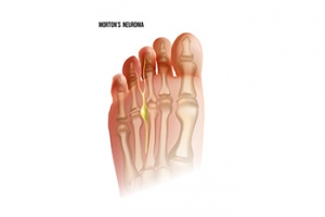 Facts About Morton&#039;s Neuroma