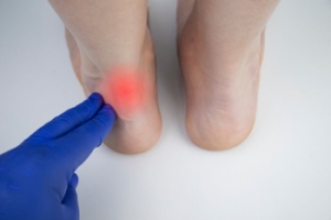 Achilles Tendon Rupture and Its Causes