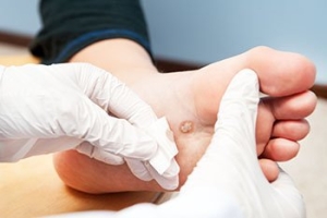 What Are Plantar Warts?