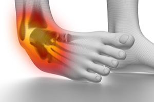 Definition and Causes of Acute Ankle Sprains