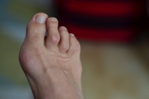 Why Are My Toes Bent Out of Shape?