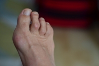 Why Are My Toes Bent Out of Shape?